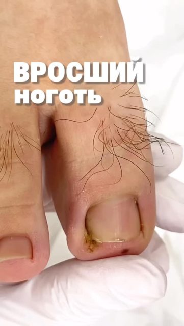 Этот момент, когда перестаёт болеть…
— ради него и проводится процедура.

Когда каждый шаг приносит дискомфорт,
даже небольшой вросший участок начинает мешать жить нормально.

Скальпель позволяет точно и аккуратно убрать источник боли,
снять давление на ткани и сразу облегчить состояние.

Без лишнего вмешательства.
Без грубых действий.
Только то, что действительно нужно в данный момент.

Результат ощущается сразу —
и это то, за чем приходят пациенты.

📩 Если сталкивались с болью — напишите нам, поможем вернуть комфорт вашим ножкам 👣

#подолог #подологалматы #алматы #консультацияподолога #вросшиеногти