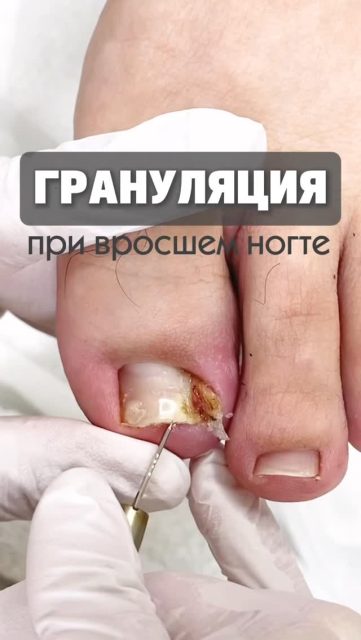 Грануляция при вросшем ногте — это не просто «нарост», а реакция кожи на постоянное раздражение и давление.

Когда ноготь врастает в боковой валик,
ткань начинает защищаться — появляется разрастание,
которое может кровить, болеть и доставлять сильный дискомфорт.

Чаще всего это уже сигнал о том, что
проблема находится не на начальной стадии и требует грамотного подхода.

Важно понимать:
просто убрать грануляцию недостаточно.
Если не устранить причину — давление и вросший сегмент —
ситуация будет повторяться.

В работе мы:
— аккуратно убираем вросший участок ногтя
— снимаем давление на ткани
— работаем с грануляцией
— подбираем дальнейшую тактику, чтобы избежать повторения

Только комплексный подход даёт заживление и устойчивый результат.

Чем раньше начать работу,
тем быстрее проходит восстановление и уменьшается риск осложнений.

📩 Если вы столкнулись с подобной ситуацией — напишите нам, поможем 👣

#подолог #подологалматы #алматы #консультацияподолога #вросшиеногти