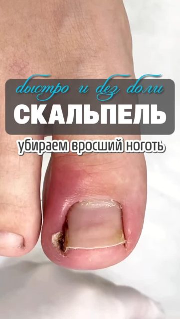 Быстро и без боли —
именно так должна проходить работа с вросшим ногтем.

Уже во время процедуры пациент чувствует,
как уходит боль и становится легче наступать.

И самое важное —
мы не просто убираем проблему «на сейчас»,
а создаём условия, чтобы ноготь рос правильно и не доставлял дискомфорт в дальнейшем.

📩 Если вы сталкиваетесь с подобной проблемой — напишите нам, поможем вернуть комфорт 👣

#подолог #подологалматы #алматы #консультацияподолога #вросшиеногти